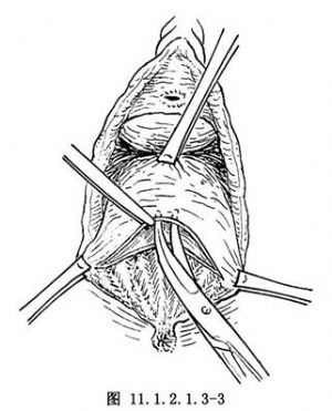 陈旧性会阴Ⅲ度裂伤修补术_损伤性疾病修复手术,外阴部手术,妇科手术