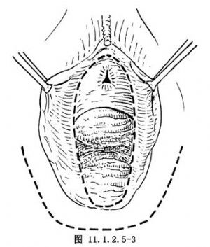 单纯性外阴切除术