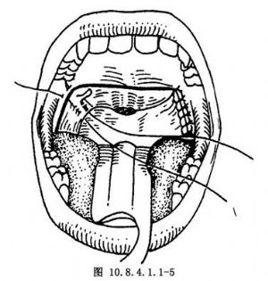 悬雍垂腭咽成形术