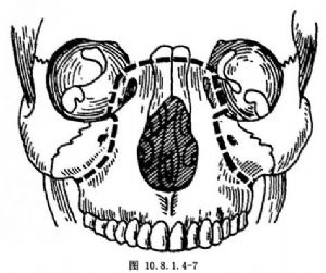 上颌骨lefortⅡ型截骨前移术_上颌骨畸形的手术矫正,手术,口腔科手术