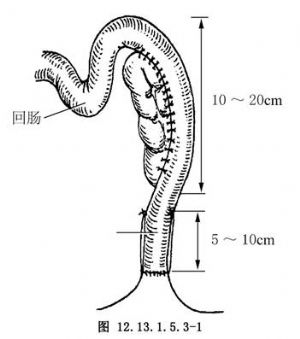 升结肠回肠侧侧吻合术