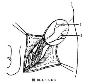 腹股沟游离皮瓣移植颊重建术