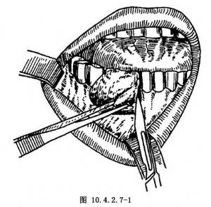 牙龈瘤切除术