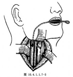 腮腺瘘图片