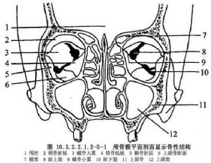 上颌骨微型钢板内固定术
