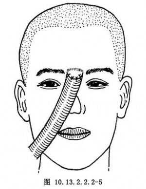 腹部皮管全鼻再造術 拼音 英文 醫學百科