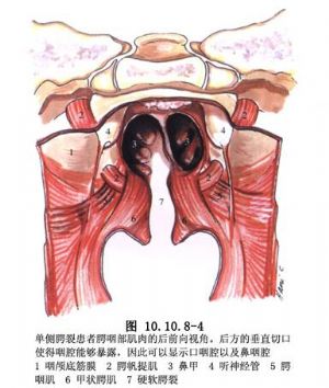 腭裂环扎术