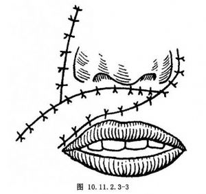 测量,设计并描画出鼻唇沟皮瓣,需要切除的唇部瘢痕及对侧鼻旁辅助切口