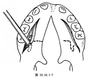 两瓣法腭裂修补术_腭裂修复术,口腔科手术,手术_医学百科