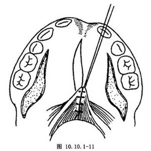 两瓣法腭裂修补术_腭裂修复术,口腔科手术,手术_医学百科