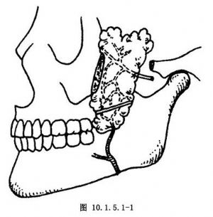 术_手术,拔牙术及牙槽外科,口腔科手术,口腔上颌窦瘘修补术_医学百科