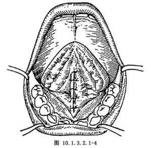 手术,拔牙术及牙槽外科,口腔科手术,系带修整术_医学百科