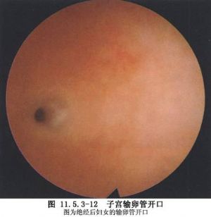 宫腔镜检查
