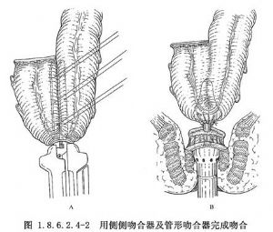 5cm的侧侧吻合器进行,长度为5～10cm,一般认为5cm贮袋效果最好,因为小