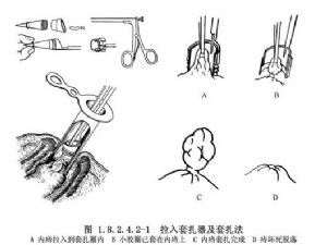 内痔胶圈套扎疗法
