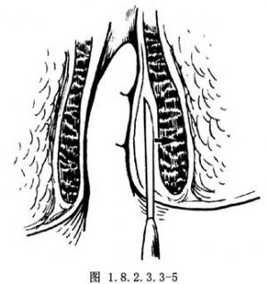后位内括约肌切断术_手术,普通外科手术,肛门,肛管的手术,肛管,直肠
