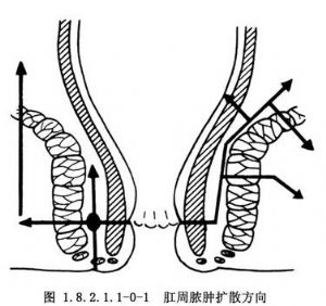 肛管直肠周围脓肿切开与一期缝合术