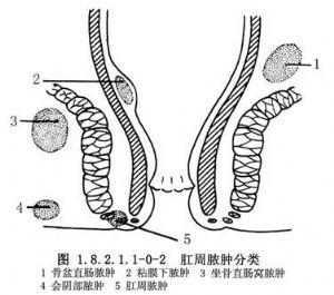 肛管直肠周围脓肿切开与一期缝合术