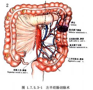 左半结肠切除术的范围包括乙状结肠,降结肠,横结肠脾曲,左半横结肠