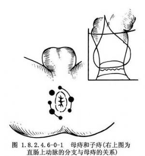血栓性痔疮清除术