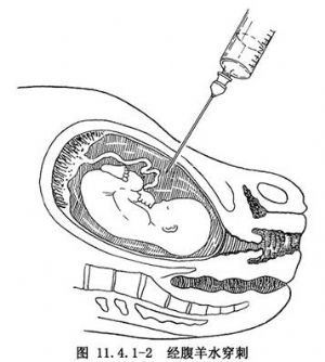 羊水穿刺