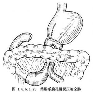 billrothi式胃次全切除术 词条正文输入空肠段梗阻:billroth Ⅱ式胃