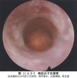 宫腔镜检查