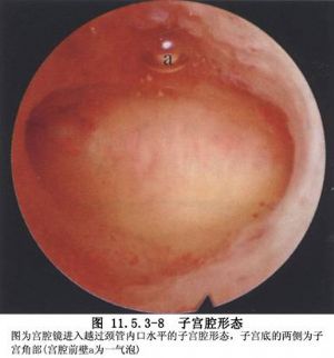 宫腔镜检查