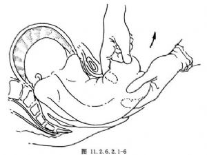 8.胎盘娩出后,仔细检查宫颈,阴道及会阴的裂伤情况,及时修补. 9.