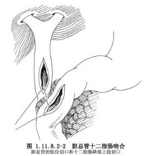 胆总管十二指肠吻合术