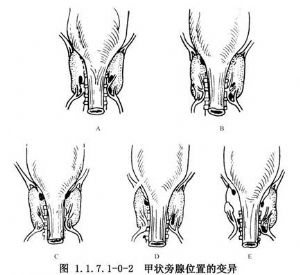 甲状旁腺切除术