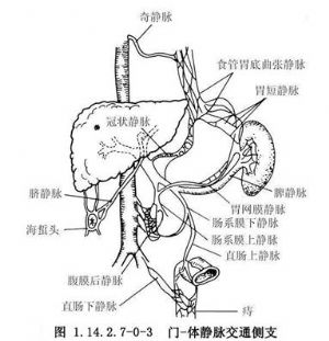 门静脉与腔静脉侧-侧分流术