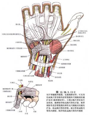环指浅屈肌腱移位重建拇指对掌功能
