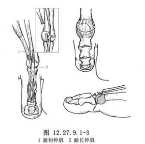 脚趾内翻手术过程图解图片