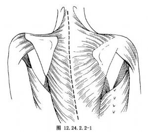 woodward肩胛骨下移术