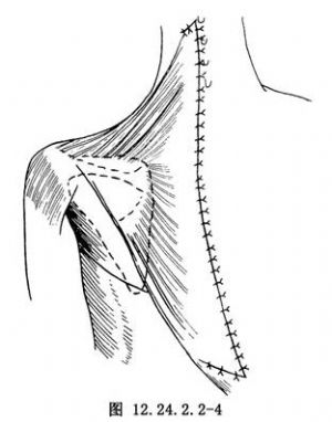 woodward肩胛骨下移术