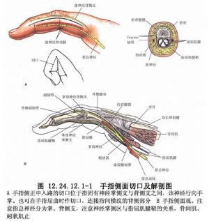 手指软组织和指神经部分切除术